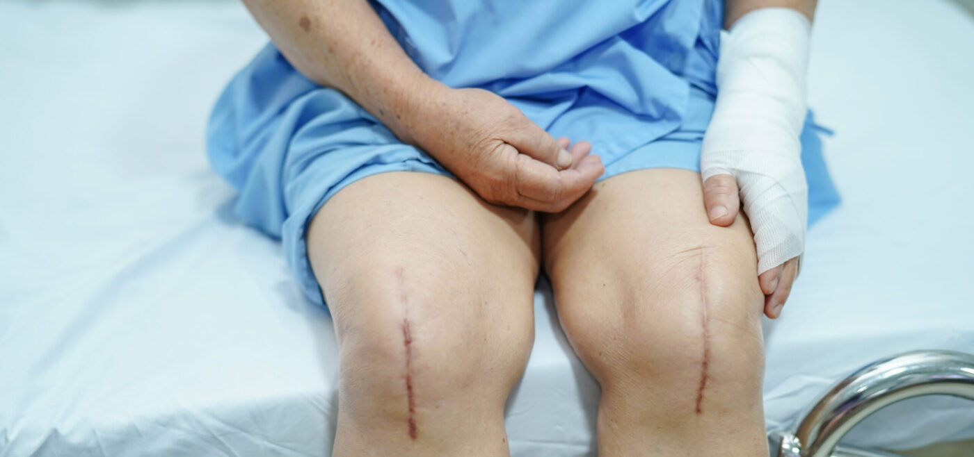 แผลกดทับ Pressure Ulcer